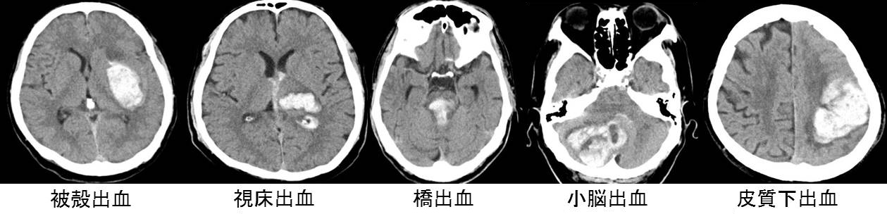 脳疾患あれこれ-症状や原因-予防などについて | 一ノ宮脳神経外科病院